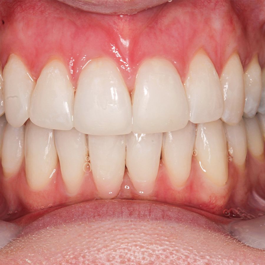 teeth cleaning after